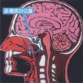 鼻咽癌化疗前为什么要拔牙,鼻咽癌治疗几年后可以拔牙种牙