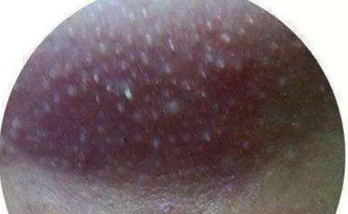 脾胃湿热粉刺怎么治,脾胃不好长粉刺怎么调理