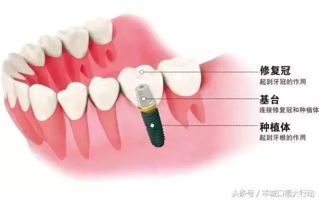 钛金种植牙的危害,正畸种植牙的危害
