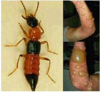 小孩被蜱虫叮咬后一直有印记,小孩子被不明昆虫叮咬多久会消肿