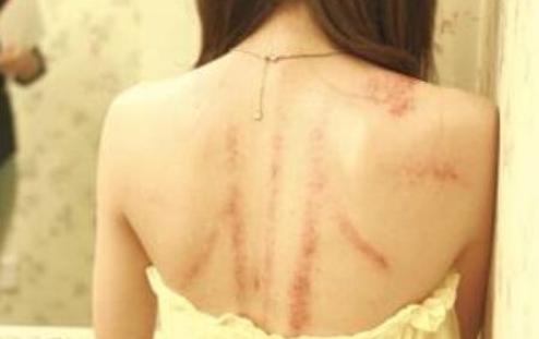 脾胃湿热粉刺怎么治,脾胃不好长粉刺怎么调理