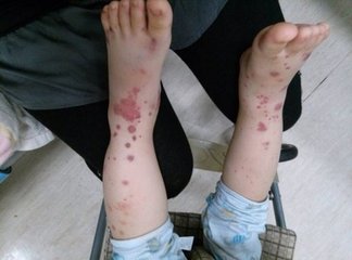 过敏性紫癜反反复复恢复的过程,儿科过敏性紫癜真实经验