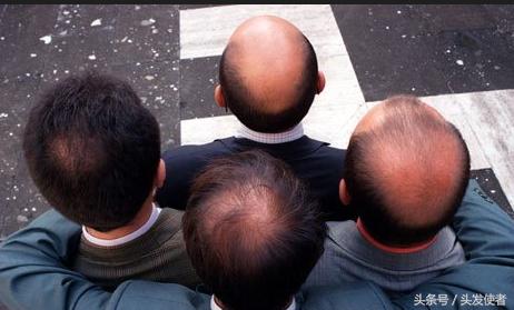 吃药后脱发停了还能恢复吗,脂溢性脱发停药会复发吗