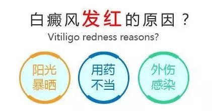 白癜风用药后脸发红是好转吗,白癜风治疗发红是有好转了吗