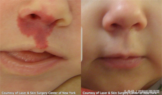 冷冻可以治疗鲜红斑痣胎记吗,治疗鲜红斑痣胎记的方法有哪些