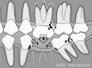 缺牙的危害素材,缺牙对人体有什么危害