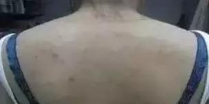 为什么会长了好多小米粒疙瘩,背后长了一粒小米粒