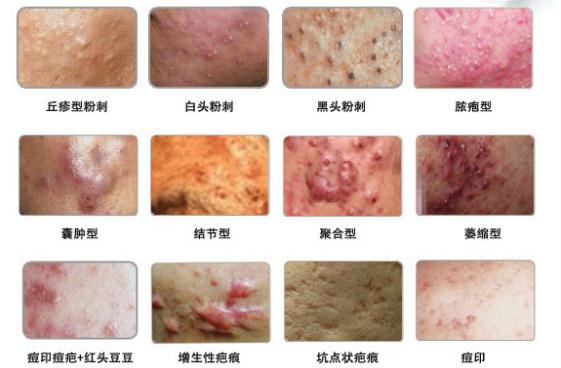 红蓝光治痘痘方法,红蓝光祛痘痘效果怎么样