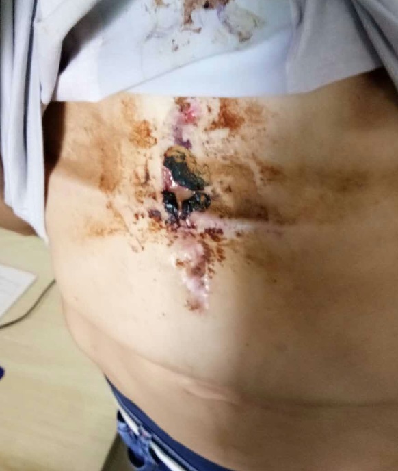 胸廓畸形能恢复吗,高难度胸廓畸形手术