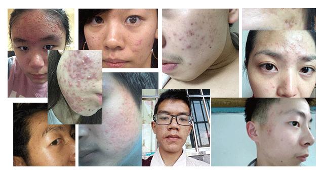 跟我这样做,不出3个月,痘痘全消散