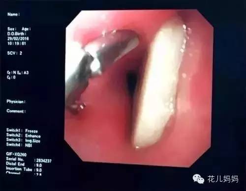 小孩骨头卡住喉咙快速解决,小男孩用一口饭救活老人