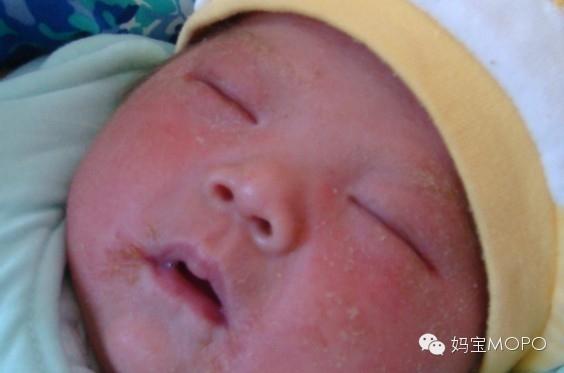 湿疹“大难题”，这些应对技巧请收好