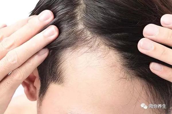 为什么男人易秃顶,为什么男人到了中年就容易秃顶呢