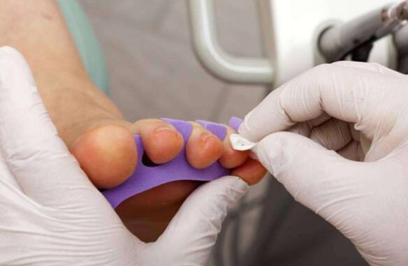 小脚趾头指甲分两瓣,如果你的小脚趾有两瓣趾甲