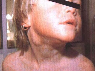 脖子淋巴肿了吃药不见效怎么办,脖子淋巴炎输液有效果吗