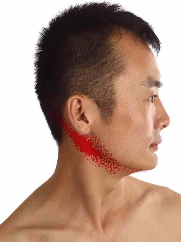 脖子肿大输液无法消退,脖子上有个疙瘩输消炎药变小