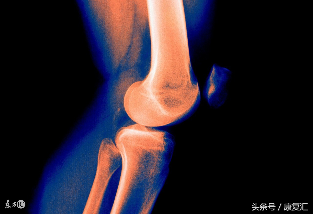 骨关节炎康复治疗的目的是,骨关节炎康复治疗浅析