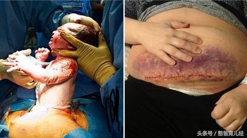 女人剖腹产后会容易得腰酸的病吗,女人剖腹产后期危害