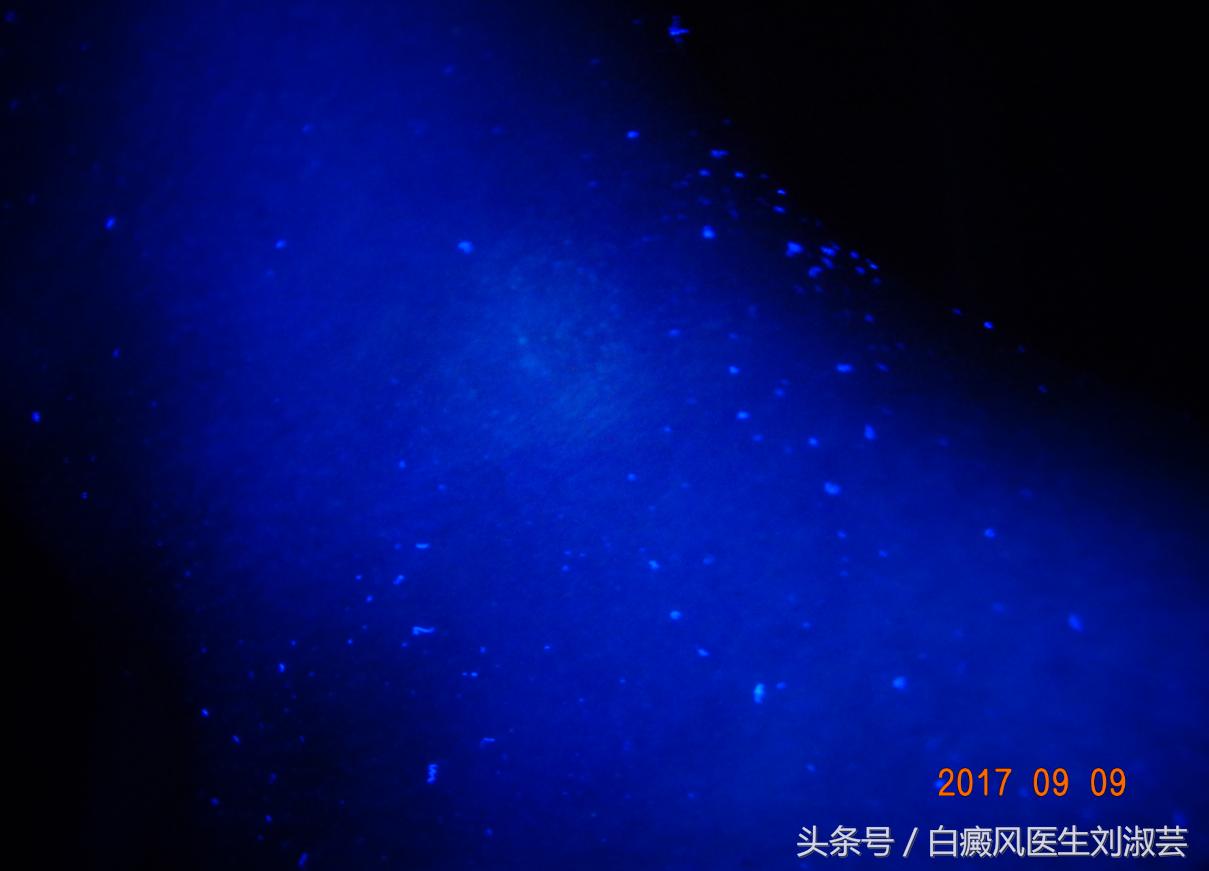 太阳晒后出现白癜风怎么修复,太阳晒伤会得白癜风吗