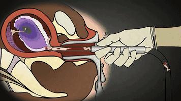 人流对生娃有什么影响,人流跟生孩子哪个危害更大