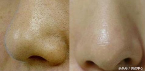 脸上油脂太多老是堵塞毛孔怎么办,油脂分泌过多毛孔堵塞导致长疙瘩