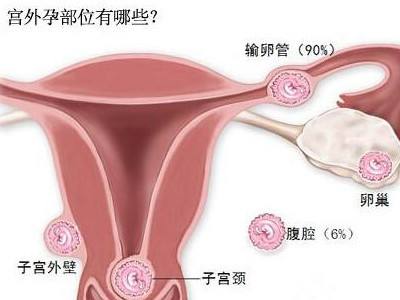 你知道宫外孕是怎么回事吗？