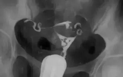 输卵管造影有多重要？这些你都知道吗？