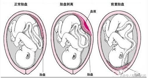 胎盘位于子宫前壁是在哪个位置,胎盘位于子宫右前壁是在哪