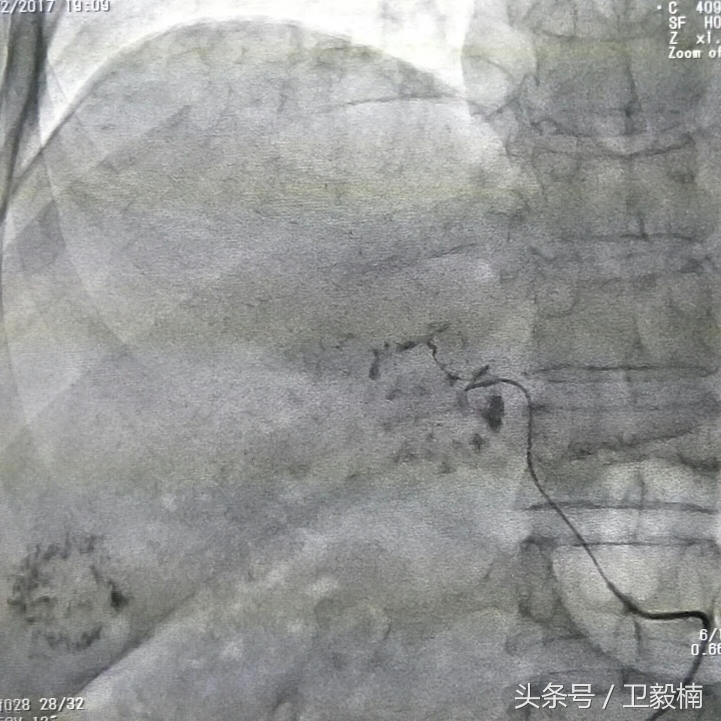 微创介入科一卫毅楠,卫毅楠运城介入治疗