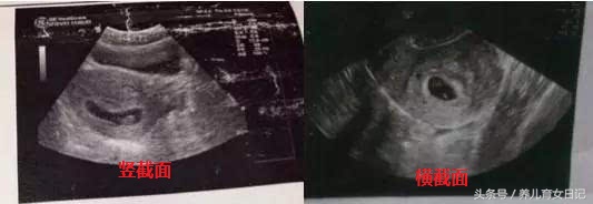 孕囊形状看阴超才准吗,孕囊形状可以看出宫缩吗