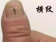 指甲竖纹变少了,指甲竖纹发白没血色
