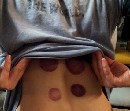 拔罐,是养生还是自虐?|话题吧