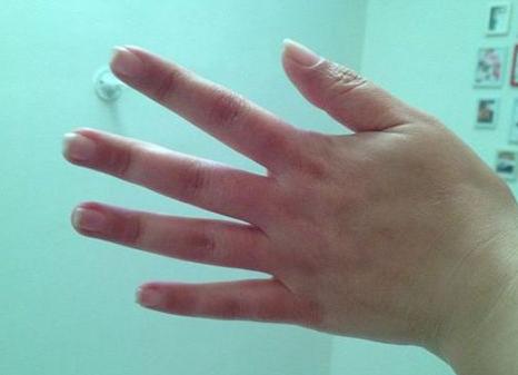 脸部冻伤用什么冻疮膏管用,冻伤可以用冻疮药膏吗