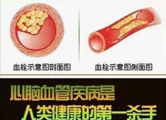 中医治疗心脑血管站桩,练太极站桩对心脑血管有帮助吗