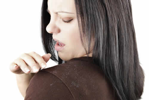 头皮屑引起脱发怎么治疗,头皮屑脱发怎么治疗最好