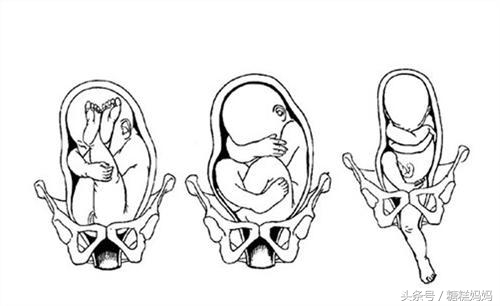 臀位破水可怕吗怎么应对,臀位宝宝孕妈妈需要怎么应对