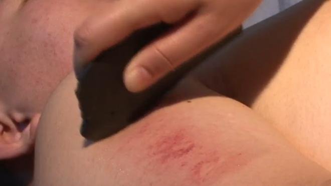 过敏性鼻炎能艾灸吗灸什么穴位,治疗过敏性鼻炎穴位有哪些