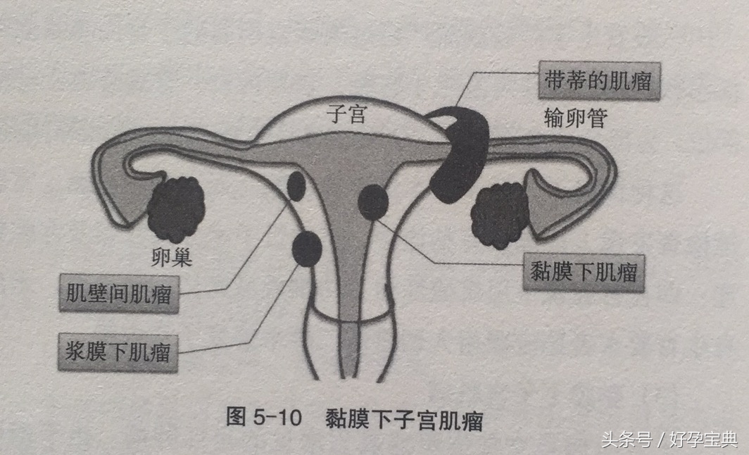 为什么宫腔会发生改变？宫腔改变为什么会导致不孕不育？