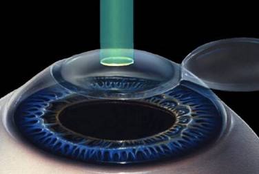 近视的干预和防治手段,近视各种疗法