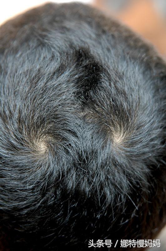 宝宝头旋儿到底有几个好?家长必须了解的秘密!