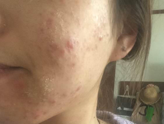 成人痘最佳治疗方法,成人痘痘不留疤痕祛除法