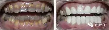 一周快速脸部美白小妙招,美容冠的形态怎么做的