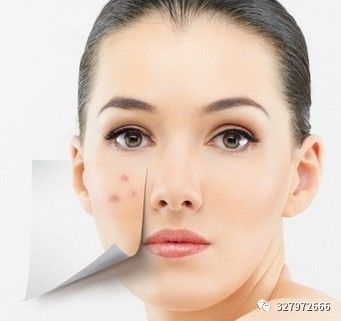 用朵嘉浓反反复复长痘,朵嘉浓治疗激素脸的例子