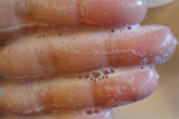 t字区为什么不能挤,t字区黑怎么回事