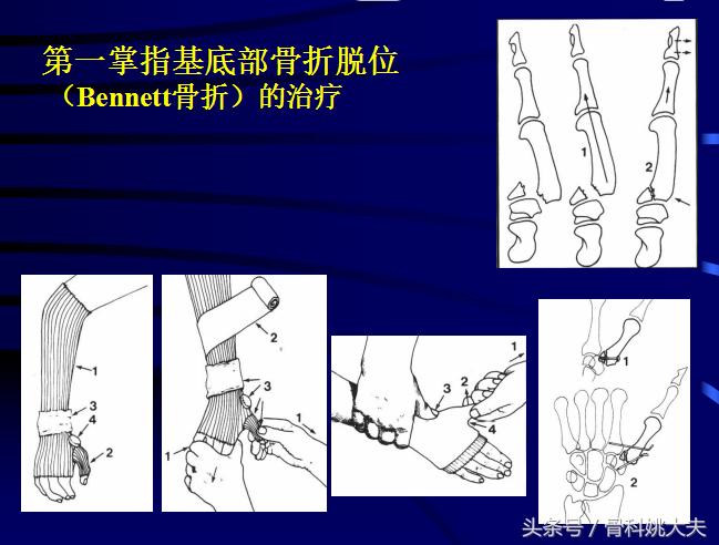 手肌腱损伤图片,手外伤神经肌腱损伤怎么定残
