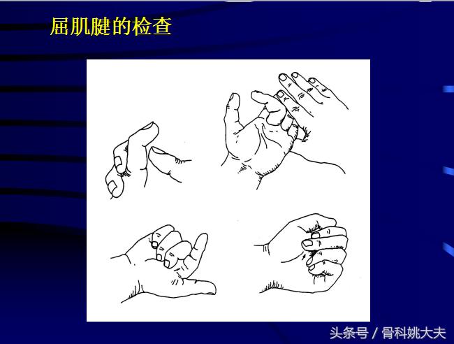 手肌腱损伤图片,手外伤神经肌腱损伤怎么定残
