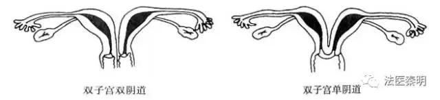 女人有两个子宫怎么办,有两个子宫怎么治疗
