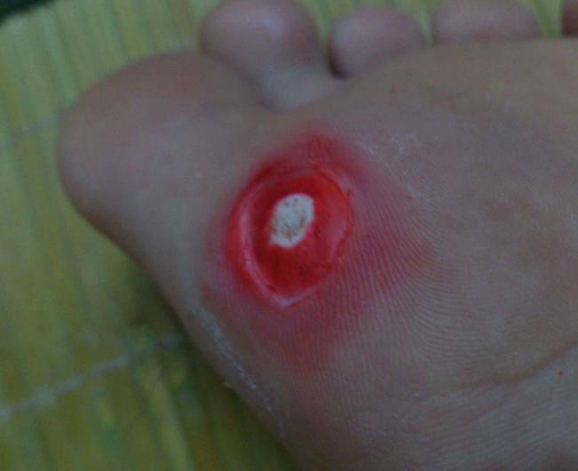 脚上长奇奇怪怪的东西是什么,脚上长像面包糠样的东西