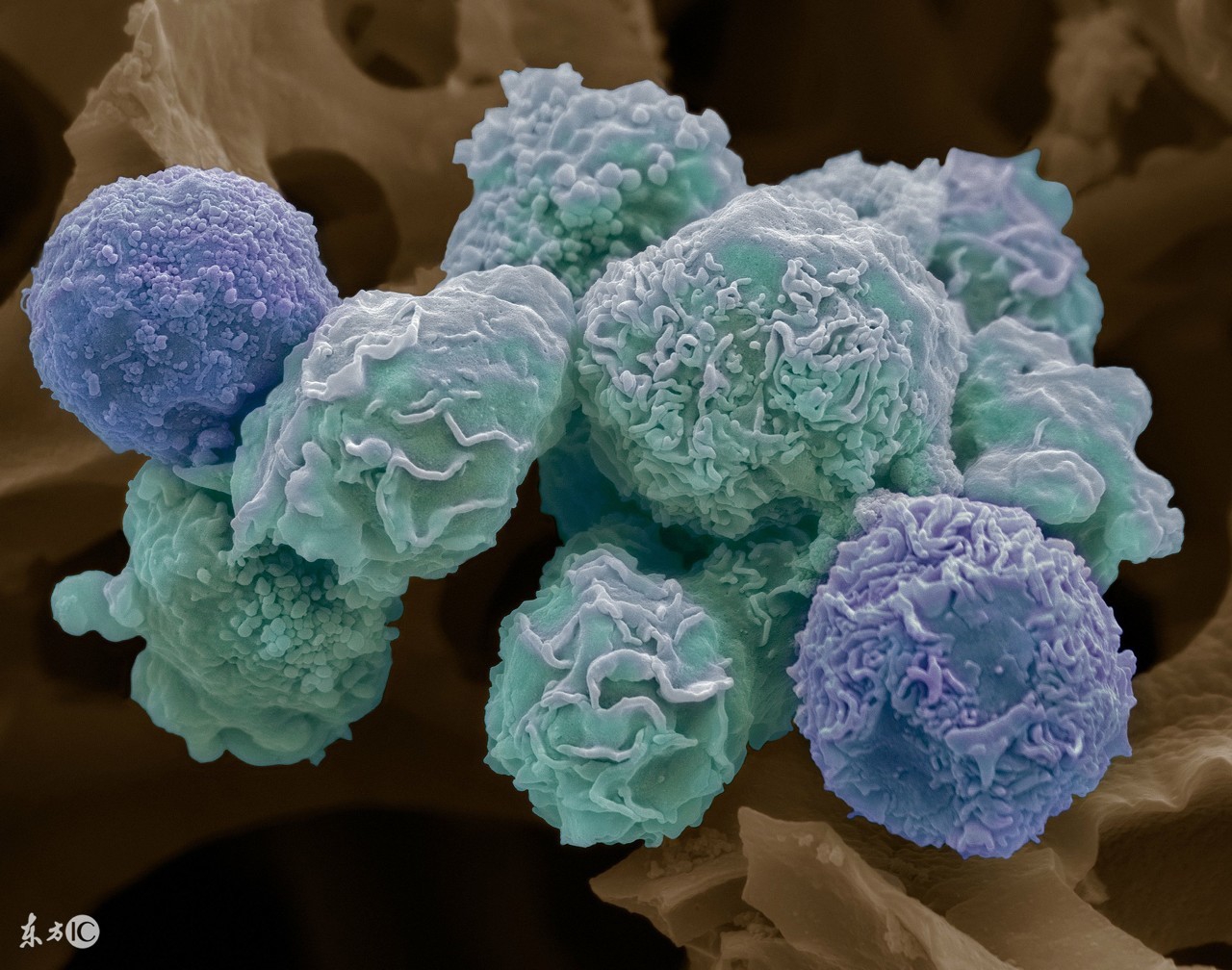 诊断子宫颈息肉较准确的方法有哪些呢