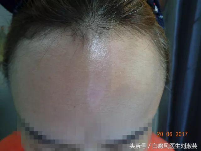 白斑病患者自述,白斑患者图片
